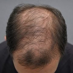 Calvície masculina